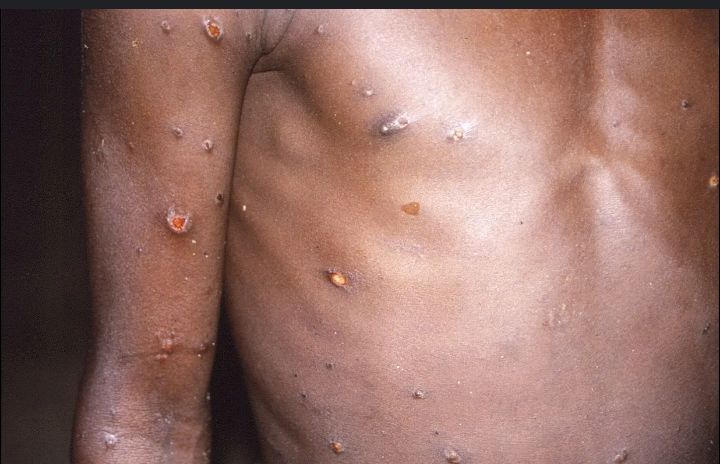 Vigilance !!! La variole du singe ou Mpox, sévit